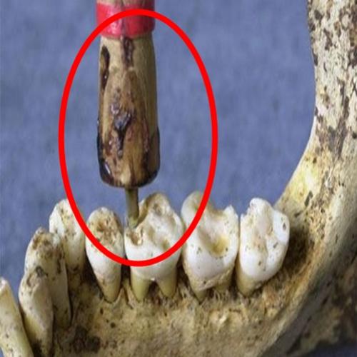 15 instrumentos horripilantes usados pelos dentistas do passado