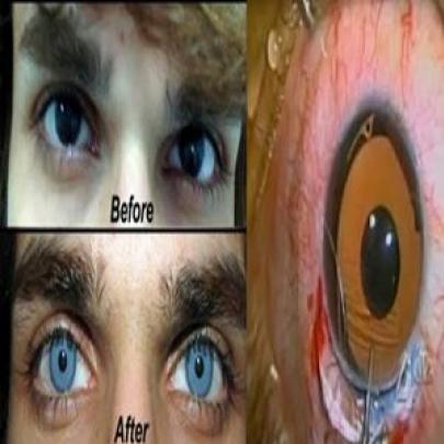 Clínicas americanas que oferecem cirurgia para mudar a cor dos olhos.