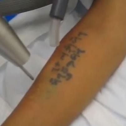 Está chegando ao Brasil, o aparelho que removerá sua tatuagem rápido