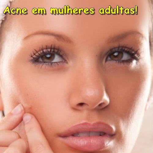 Acne na mulher adulta !