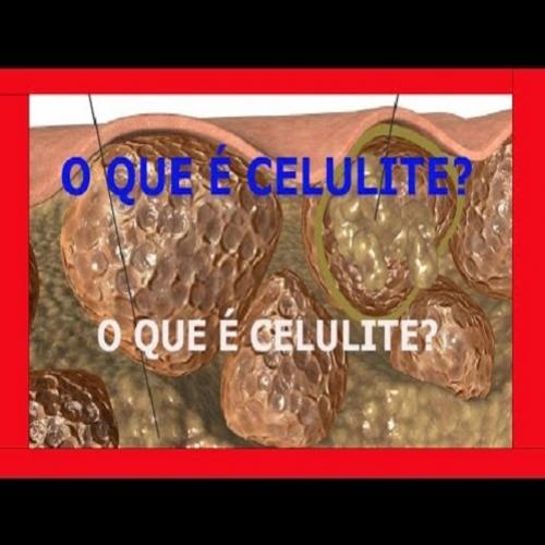 O Que É Celulite? (VÍDEO) O Que É Celulite E Como É Formada?!