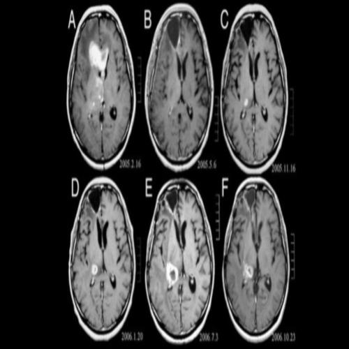 Estudo busca aperfeiçoar diagnóstico por imagem da esquizofrenia