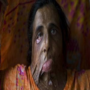 mulheres queimadas com ácido no Paquistão