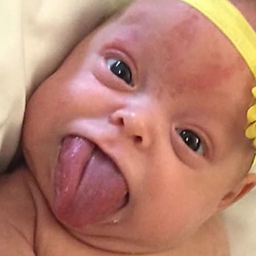 Caso raro: Bebê nasce com língua gigantesca