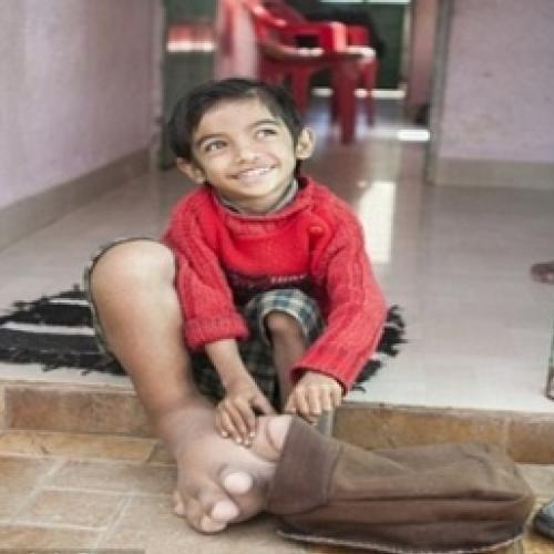 Índia:Garoto com pé gigante deixa médicos perplexos