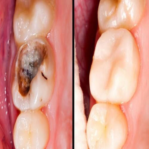 Reverta as cáries em casa, apenas com uma dieta e uma creme dental 