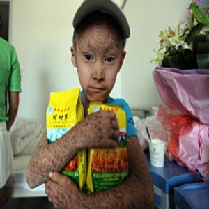 Criança com doença de pele é chamada de 'menino-peixe' na China 
