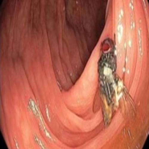 Médicos encontram mosca viva no intestino de paciente durante exame
