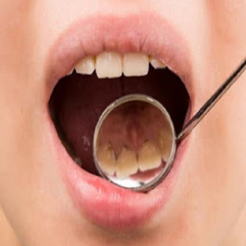  Remova o tártaro dos seus dentes de forma natural