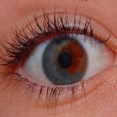 Heterocromia, os olhos multicoloridos