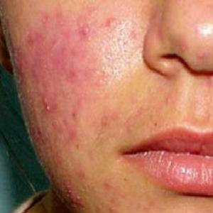 6 Dicas para acabar com a acne