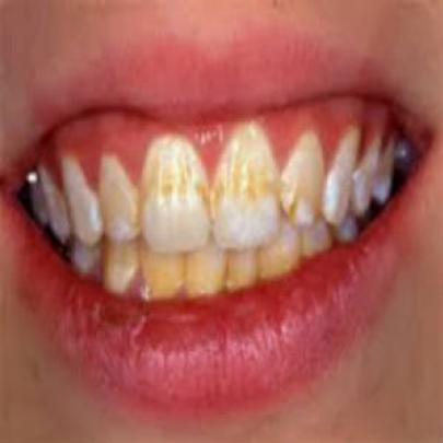 Como tirar manchas amarelas dos dentes
