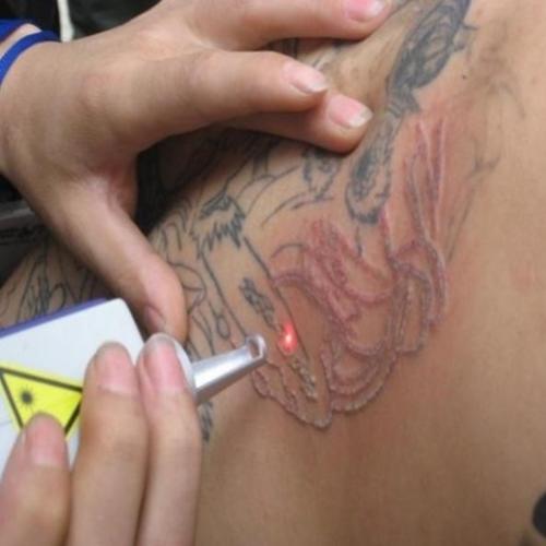 Vídeo: como funciona a remoção de tatuagens por laser