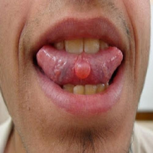 Mucocele - bolha provocada por acúmulo de saliva