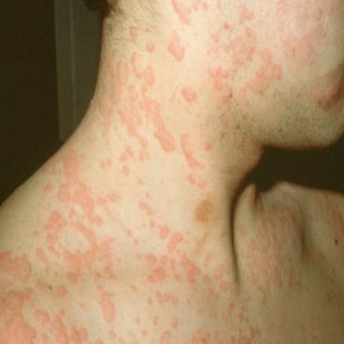 Alergia, o que é ,e se têm cura?