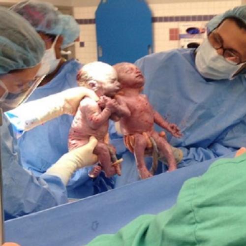 Gêmeas nascem de mãos dadas durante o parto! 