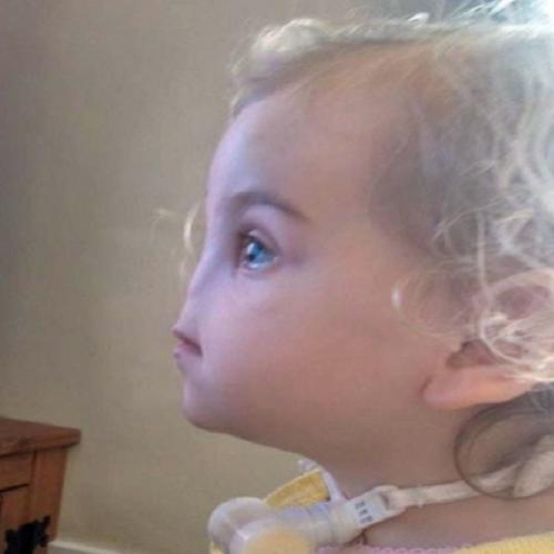  Menina que nasceu sem nariz terá prótese feita por impressora 3D 