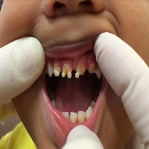 Saiba por que o dentista teve que arrancar 11 dentes de um menino...