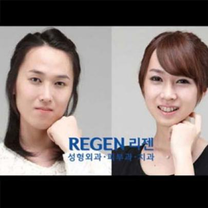 Jovens coreanos antes e depois de cirurgias plásticas extremas