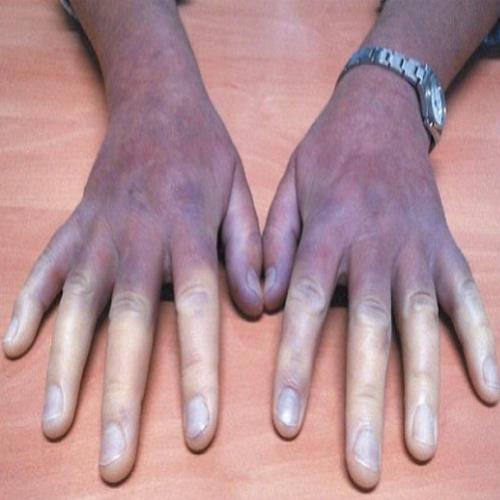  7 sinais de que você pode ter a síndrome de Raynaud 