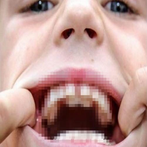 Menino-tubarão: inglês de 8 anos desenvolve segunda arcada dentária