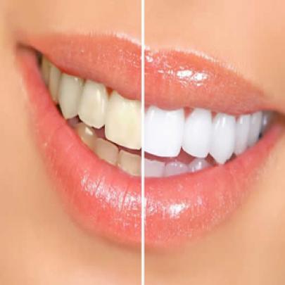 O quanto é seguro o clareamento dos dentes?