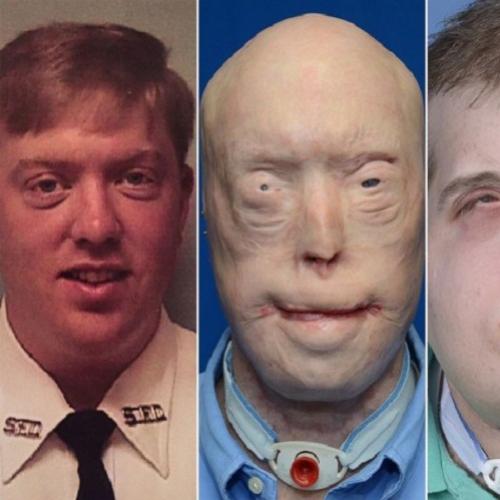Saiba como ficou a aparência do primeiro transplante de rosto do mundo