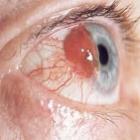 Paraneoplasia de olho: que patologia é essa?