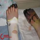 Garota mutila os pés acidentalmente por vício em videogames