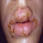 Mononucleose infecciosa: Doença do beijo.