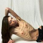 Anorexia fotos chocantes e rais 