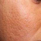 Tratamento caseiros para melhorar a aparecia das cicatrizes de acne