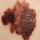 Os números alarmantes do câncer de pele