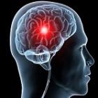 Acidente Vascular Cerebral - causas, sintomas e prevenção