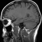 Proteína influi na formação de tumor cerebral