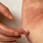 Nanoemulsão de óleo de arroz alivia inflamações da pele