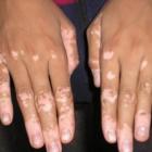 O que é vitiligo?