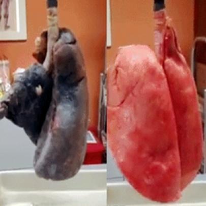 Pulmão saudável vs pulmão de fumante