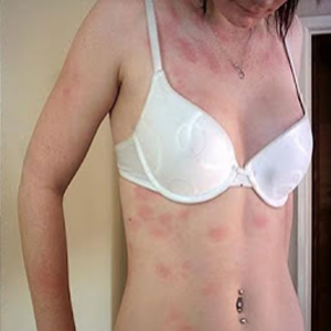 Mulher que tem alergia á água-Urticária Aquagênica