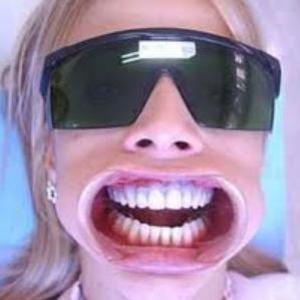 Efeitos colaterais do clareamento dental