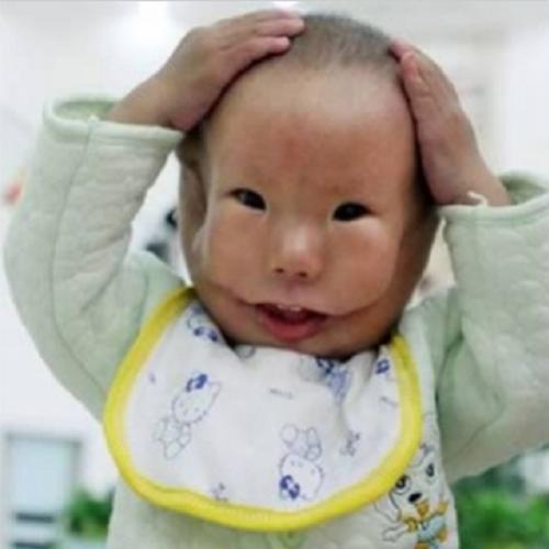  Menino nasce com rosto duplo por malformação genética 