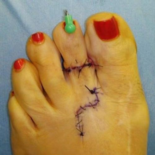 A cirurgia cosmética dos pés é a mais recente tendência bizarra ...