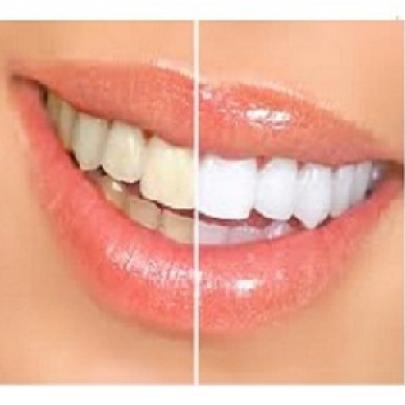 Quer Dentes Brancos? 6 - Dicas Caseiras Para Deixar e Manter Seus Dent