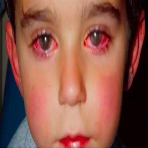Esta criança perdeu 75% da visão por causa de um brinquedo