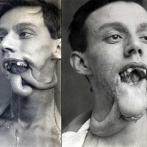 Cirurgia de reconstrução facial realizada em 1916