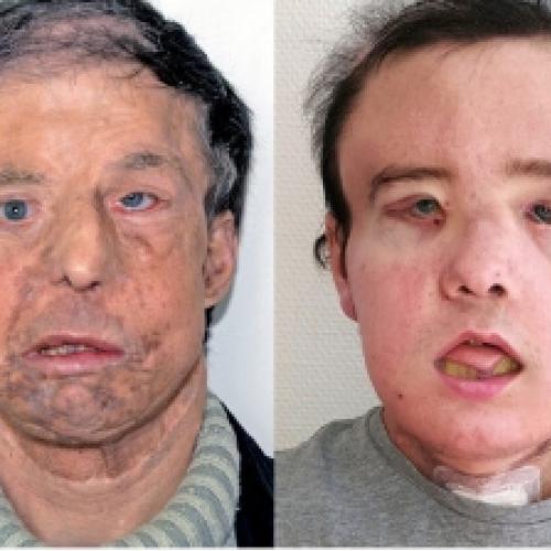 Um homem francês passou por três transplantes de rosto.