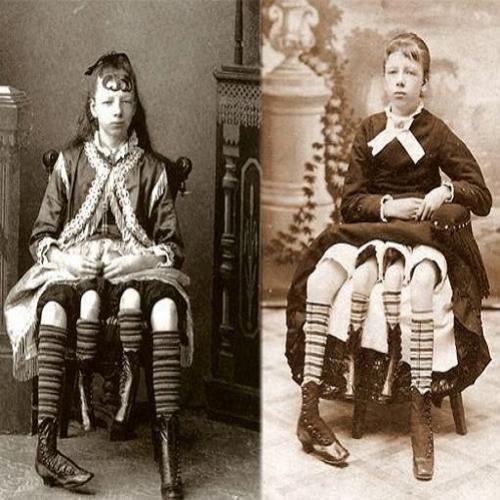 Conheça a história de Myrtle Corbin, a mulher de quatro pernas