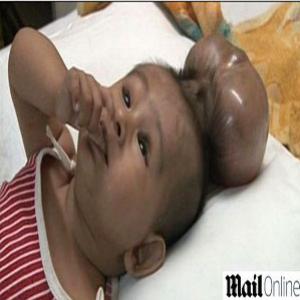 Bebê com duas cabeças: médicos chamam o caso de “gêmeo parasita” 