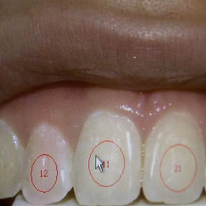 Dimensão de dentes permite fazer distinção entre os sexos