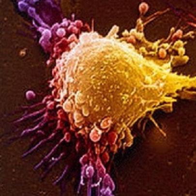 7 coisas que você precisa saber sobre o cancro